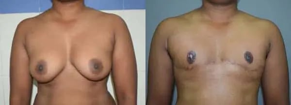 gender reassignment before and after photo by chennai plastic surgery in india