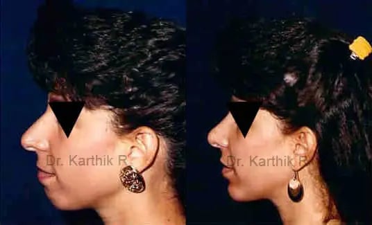 rhinoplasty before and after photo by chennai plastic surgery in india