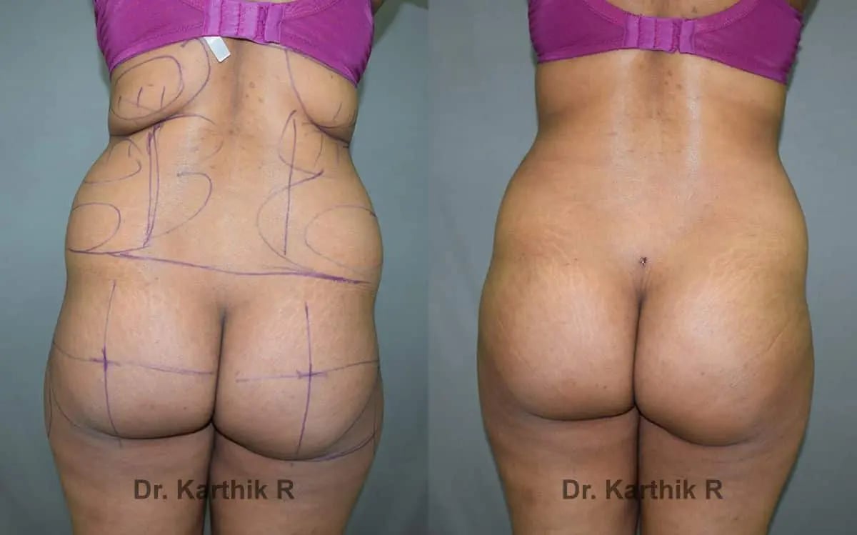 butt lift before and after photo by chennai plastic surgery in india