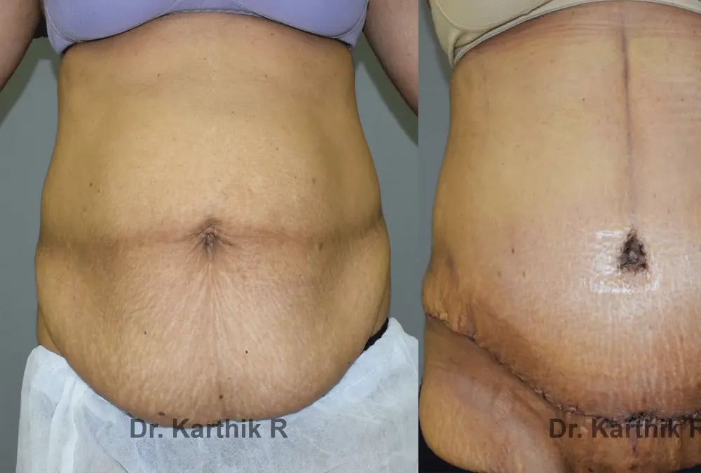 mommy makeover before and after photo by chennai plastic surgery in india
