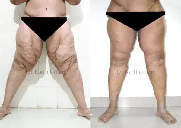 thigh lift before and after photo by chennai plastic surgery in india