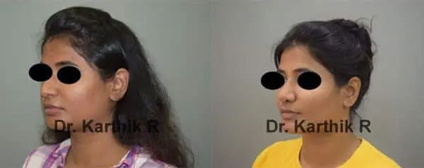 buccal fat before and after photo by chennai plastic surgery in india