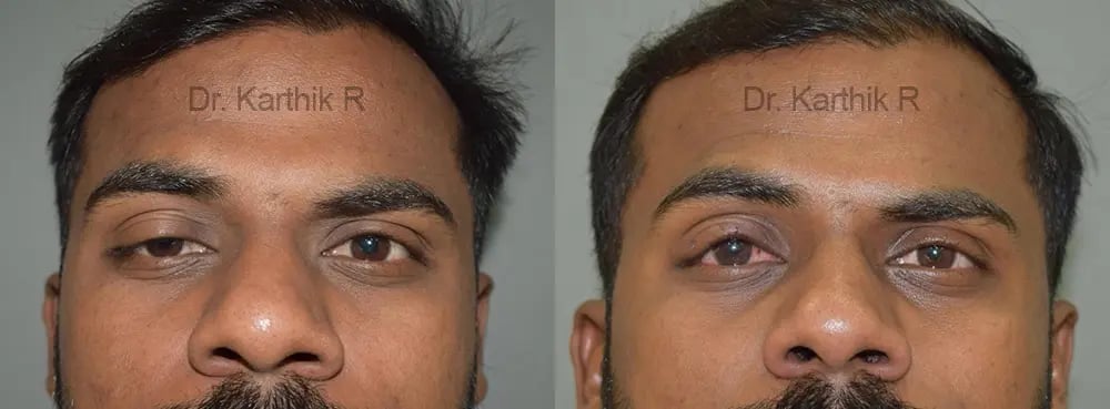 blepharoplasty before and after photo by chennai plastic surgery in india