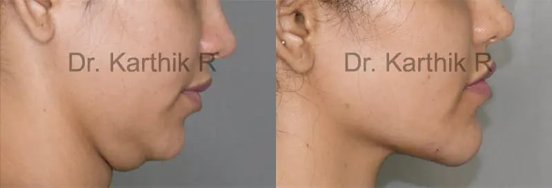 double chin liposuction before and after photo by chennai plastic surgery in india
