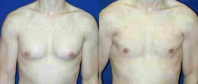 gynecomastia before and after photo by chennai plastic surgery in india