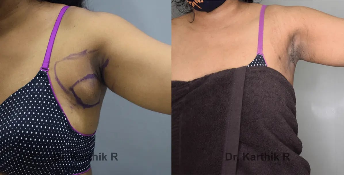 axillary tail of breast before and after photo by chennai plastic surgery in india