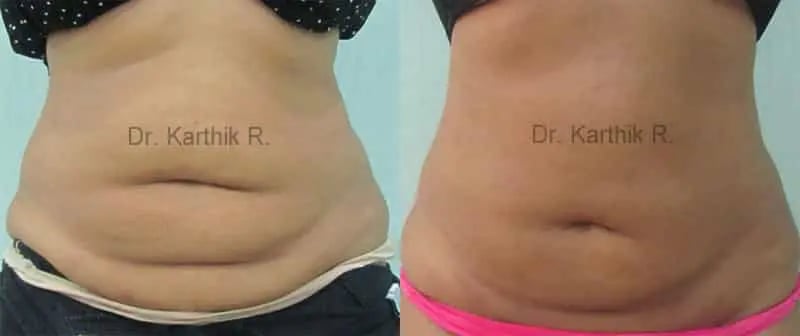 exilis before and after photo by chennai plastic surgery in india