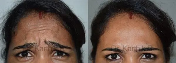 botox before and after photo by chennai plastic surgery in india