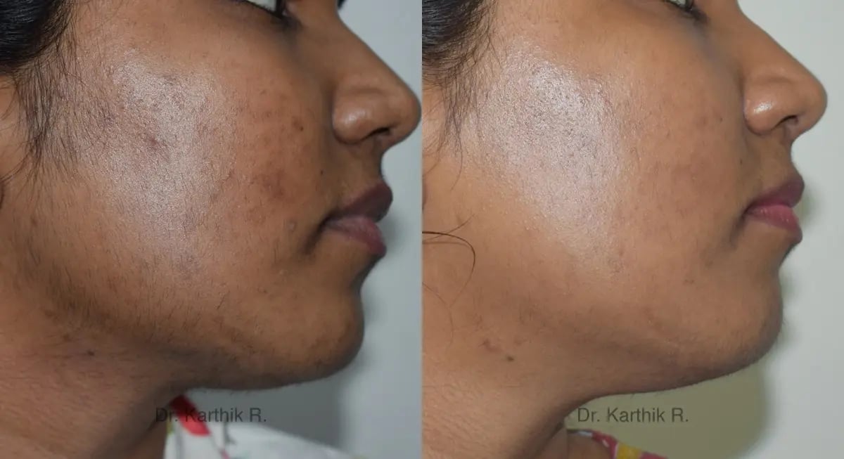 chemical peels microdermabrasion before and after photo by chennai plastic surgery in india