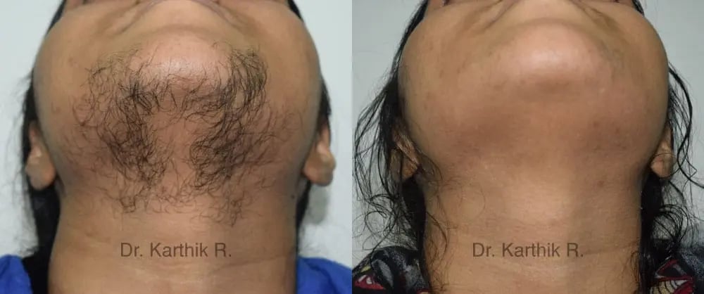 laser hair reduction before and after photo by chennai plastic surgery in india