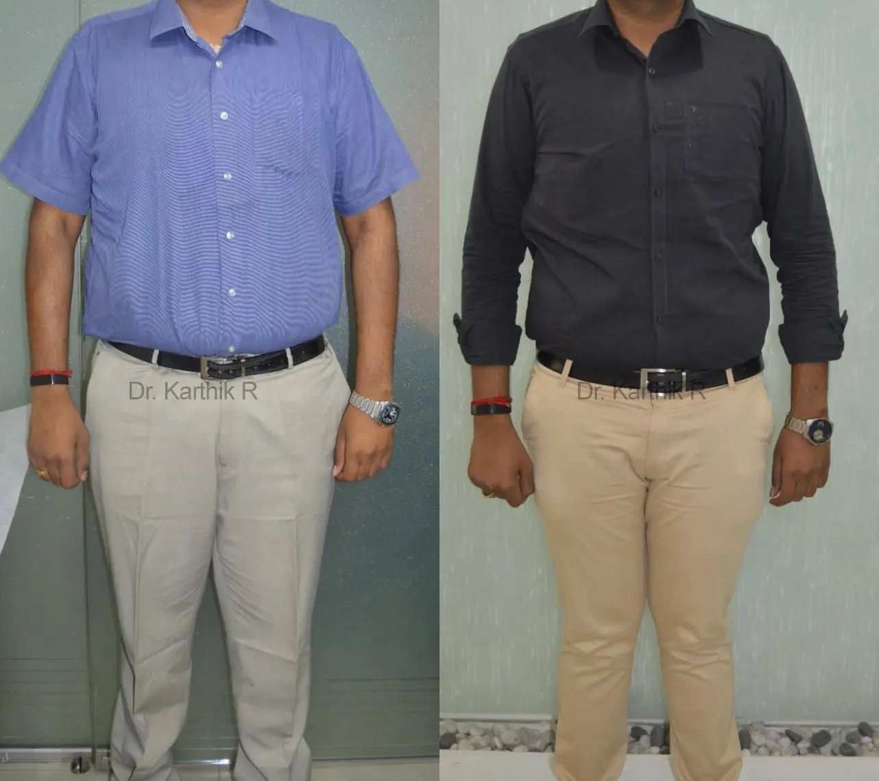 weight loss program before and after photo by chennai plastic surgery in india