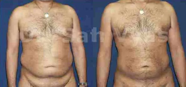 liposuction tummy back before and after photo by chennai plastic surgery in india
