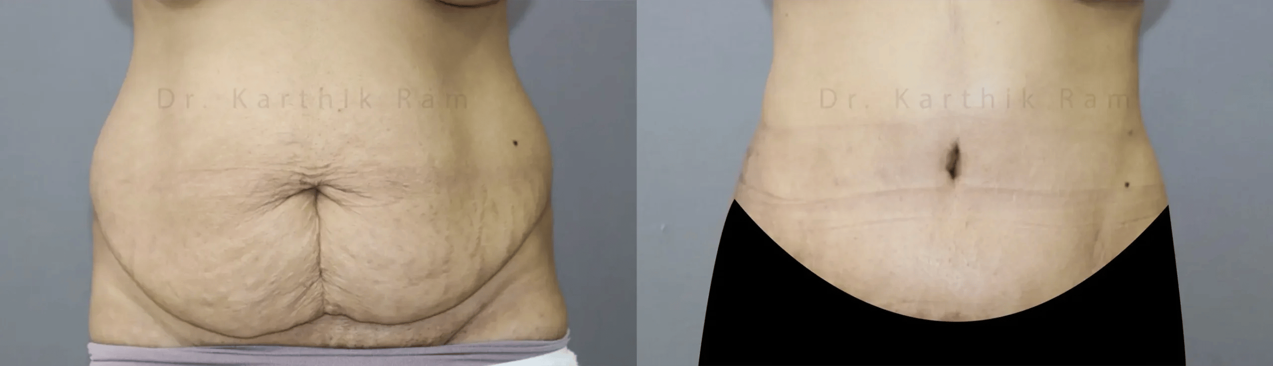 tummy tuck before and after photo by chennai plastic surgery in india