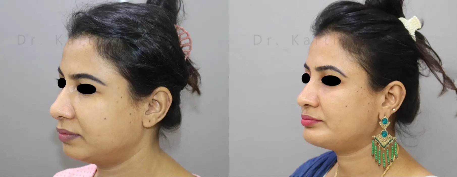 chin implant before and after photo by chennai plastic surgery in india