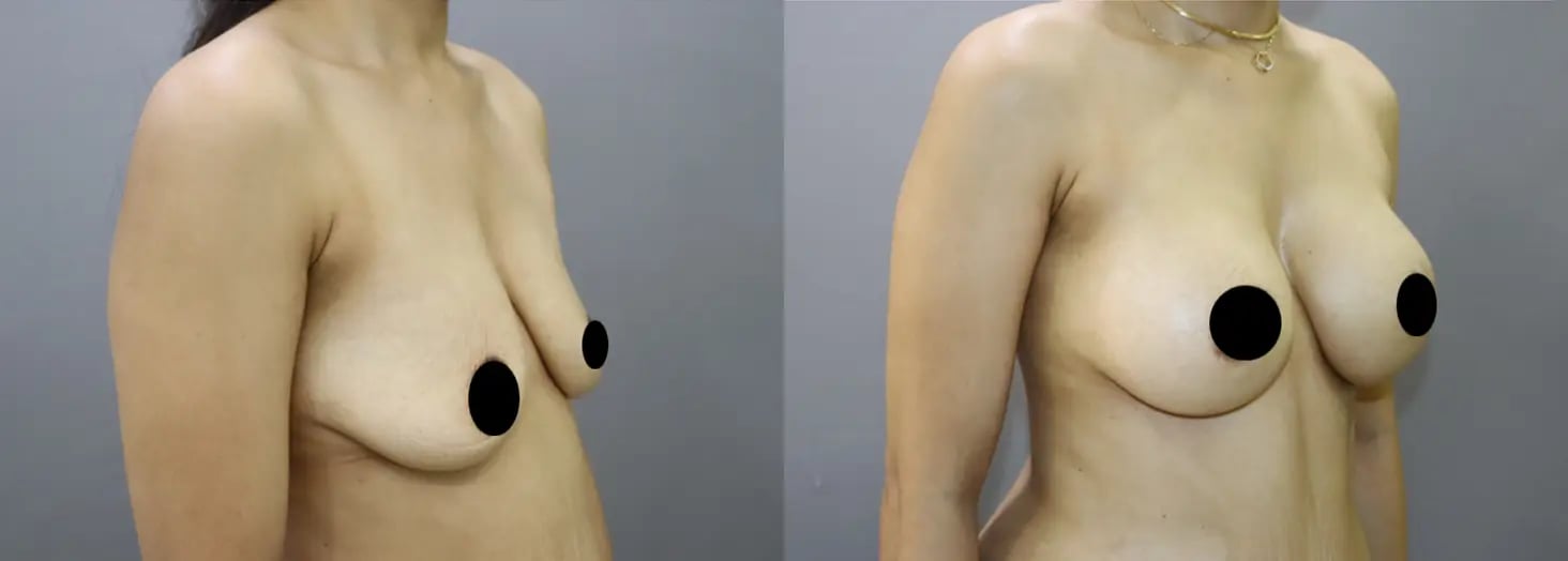 breast implants before and after photo by chennai plastic surgery in india