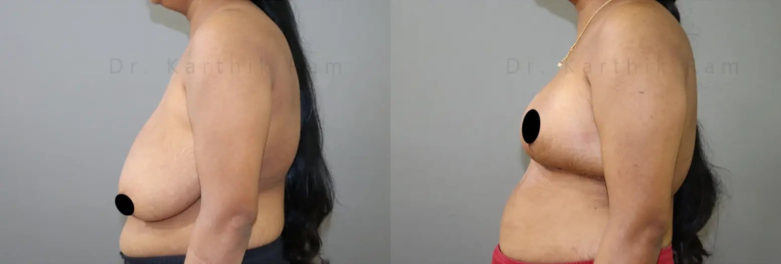 breast reduction before and after photo by chennai plastic surgery in india