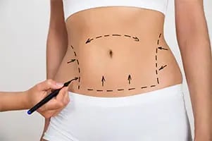 female patient with pre-surgery markings on tummy
