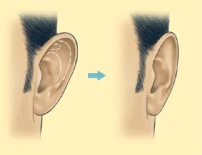 otoplasty before and after illustration