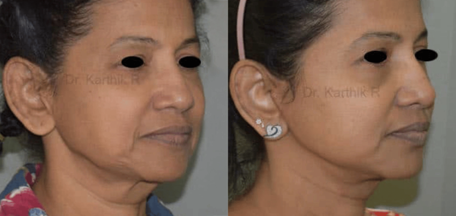 before and after facelift