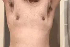 Crater Deformity after