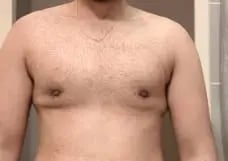Crater Deformity Before