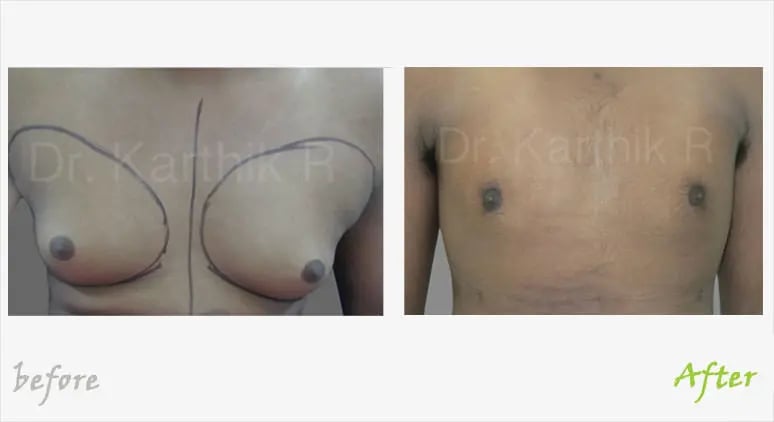 Gynecomastia Before and after