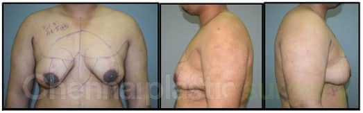 gynecomastia grade gynecomastia grade