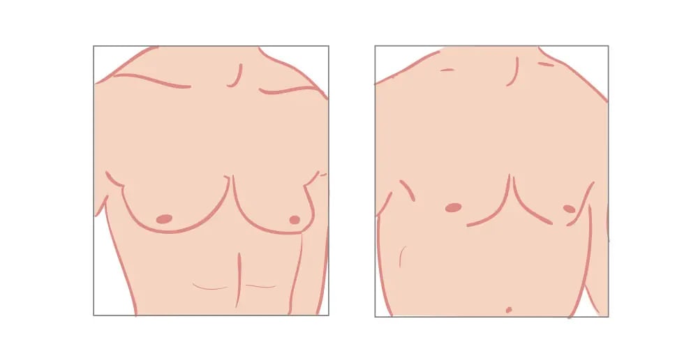 gynecomastia