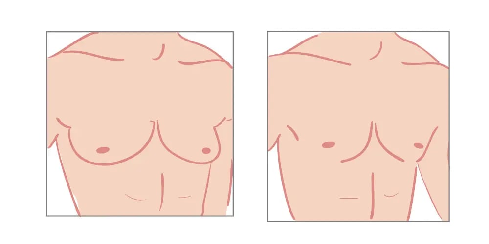 gynecomastia myth