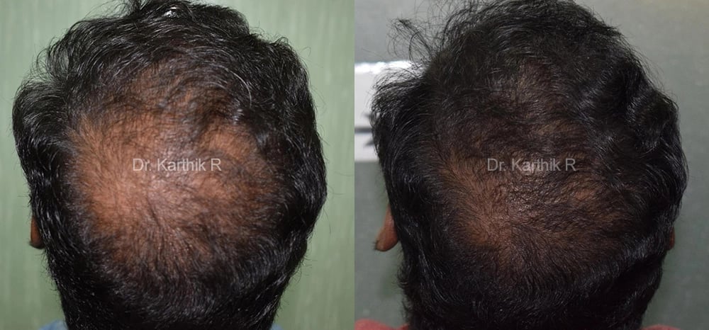 dermaroller scalp before and after photo by chennai plastic surgery in india