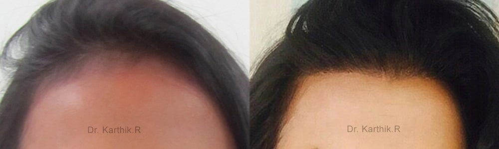 female hair transplant before and after photo by chennai plastic surgery in india