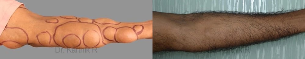 multiple lipoma before and after photo by chennai plastic surgery in india