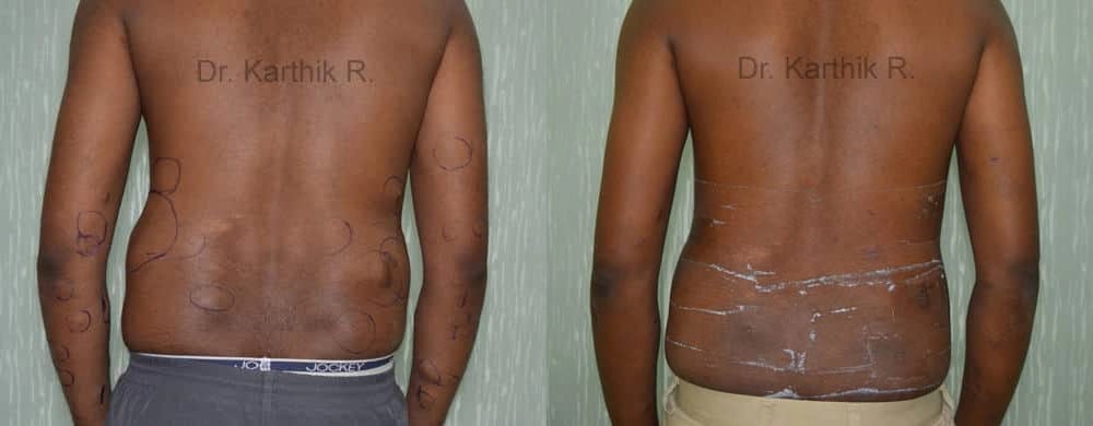 multiple lipoma before and after photo by chennai plastic surgery in india