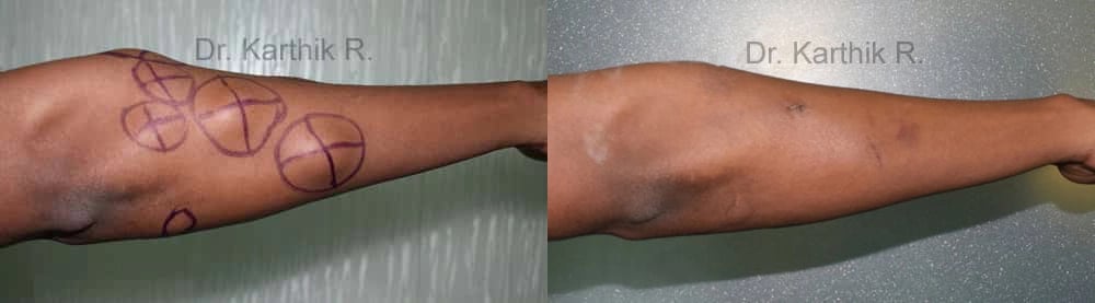 multiple lipoma before and after photo by chennai plastic surgery in india