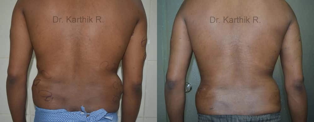 multiple lipoma before and after photo by chennai plastic surgery in india