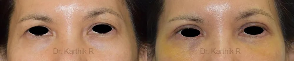blepharoplasty before and after photo by chennai plastic surgery in india