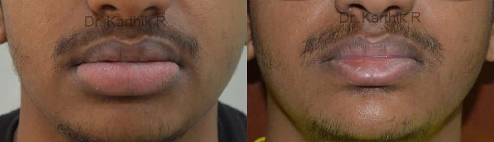 lip correction before and after photo by chennai plastic surgery in india