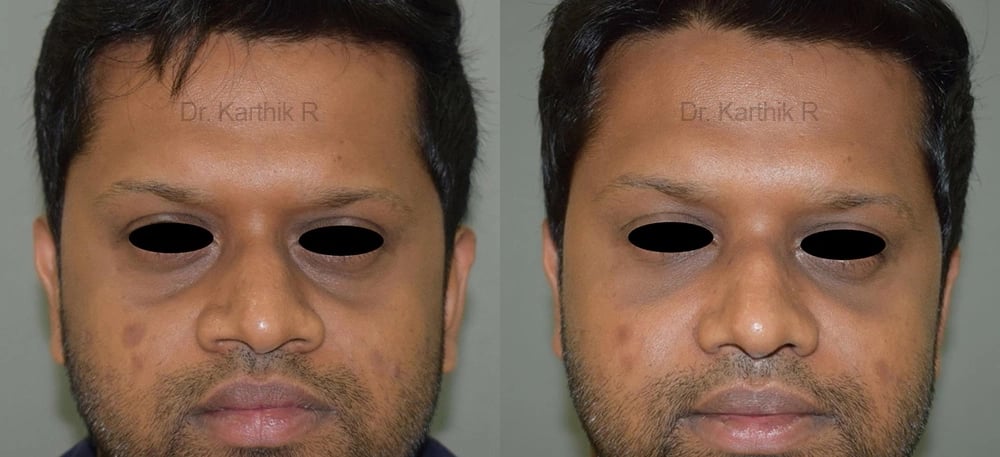 fat graft fat fill fat transfer before and after photo by chennai plastic surgery in india