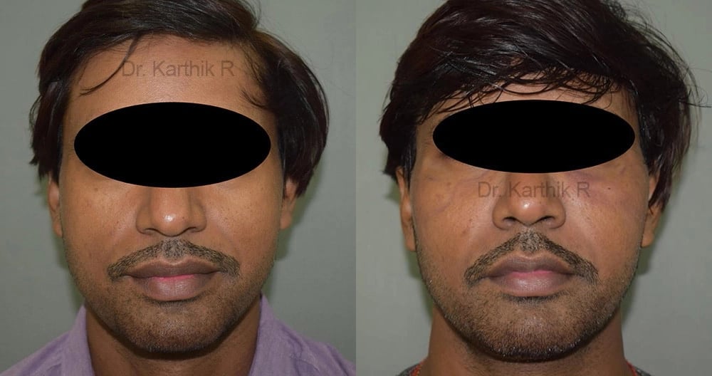 fat graft fat fill fat transfer before and after photo by chennai plastic surgery in india