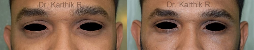 under eye fat fill before and after photo by chennai plastic surgery in india