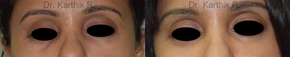 under eye fat fill before and after photo by chennai plastic surgery in india