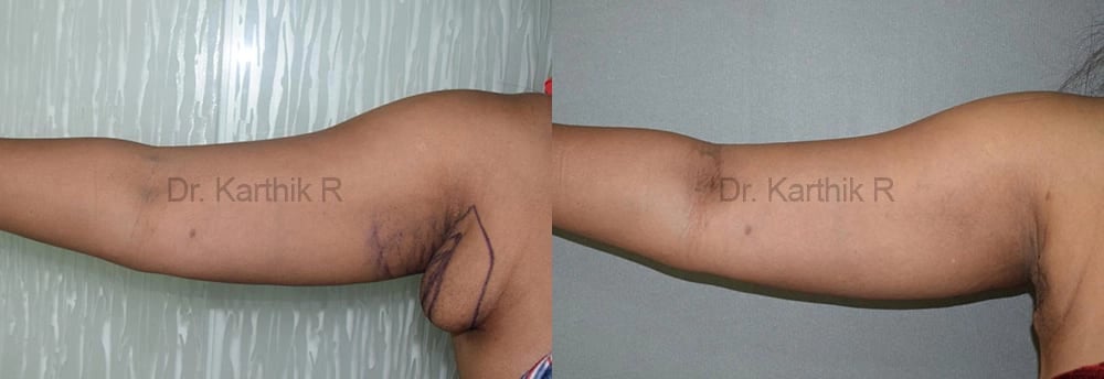 axillary tail of breast before and after photo by chennai plastic surgery in india