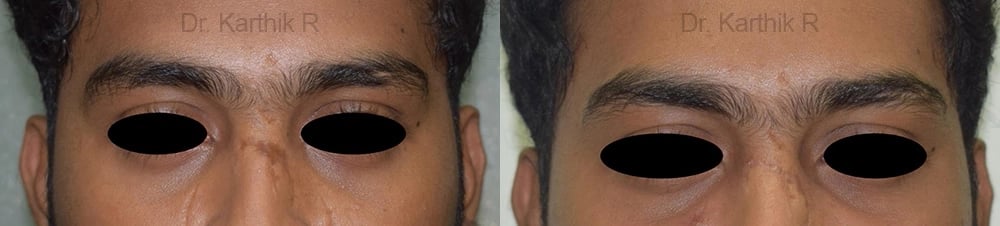 scar revision before and after photo by chennai plastic surgery in india