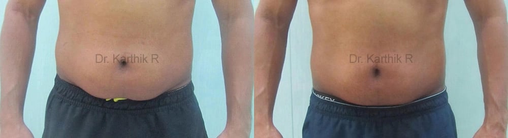 exilis before and after photo by chennai plastic surgery in india