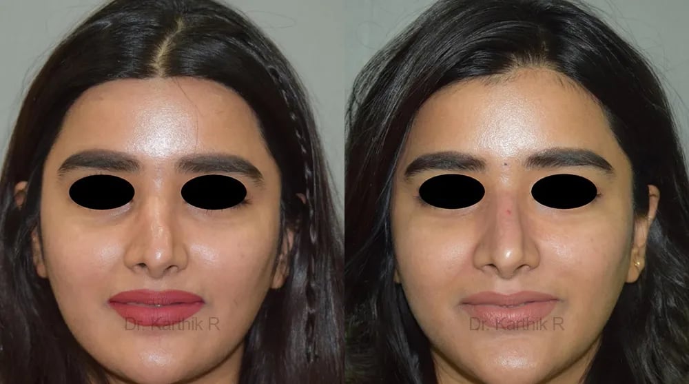 dermal fillers before and after photo by chennai plastic surgery in india