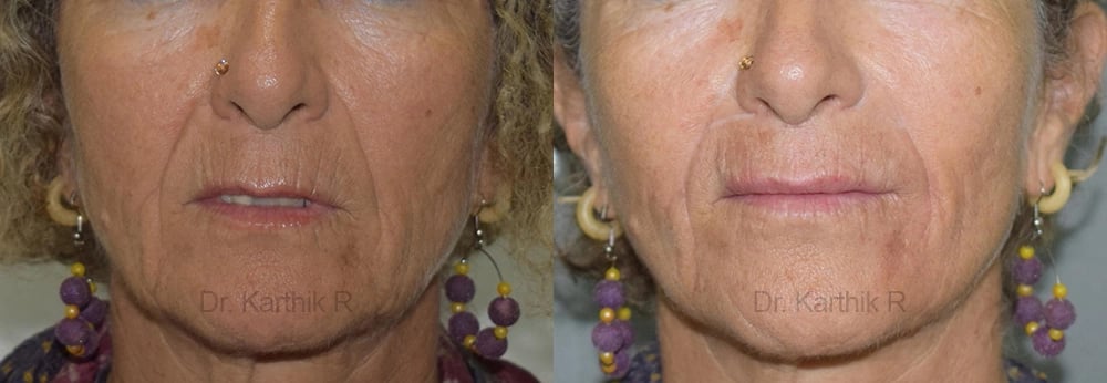 dermal fillers before and after photo by chennai plastic surgery in india