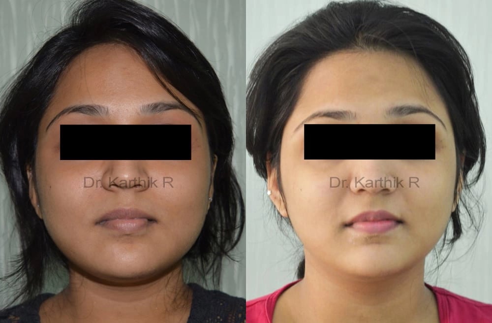 botox before and after photo by chennai plastic surgery in india