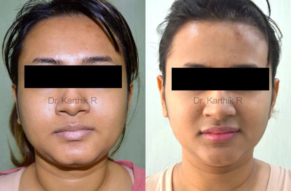 botox before and after photo by chennai plastic surgery in india