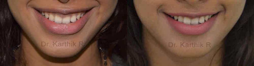 botox before and after photo by chennai plastic surgery in india