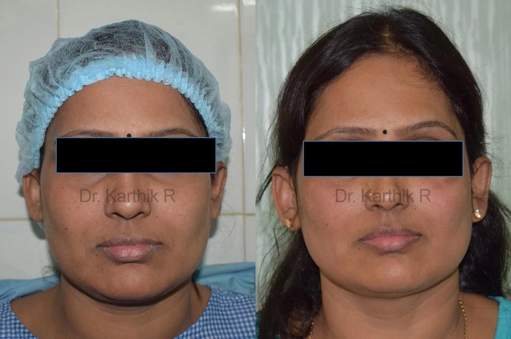 thread lift before and after photo by chennai plastic surgery in india